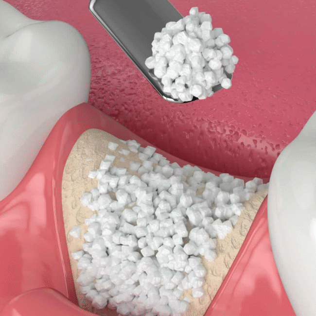 Allografts